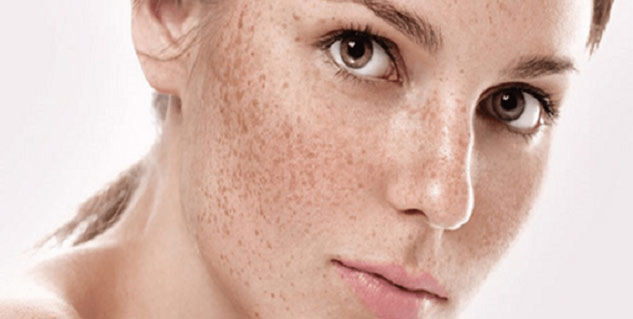 pimple marks remedies