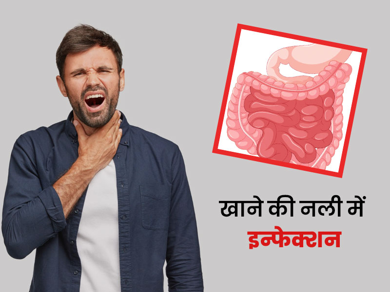 खाने की नली में इन्फेक्शन का कारण क्या है? डॉक्टर से जानें इसके लक्षण और बचाव के उपाय