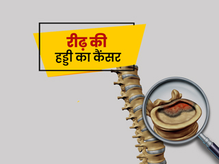 रीढ़ की हड्डी कैंसर के लक्षण, कारण और बचाव के तरीके