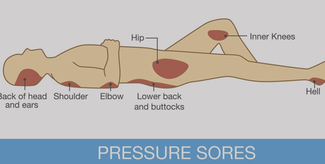 Here's How to Help a Bedsore or Pressure Ulcer Heal – Home Care Delivered