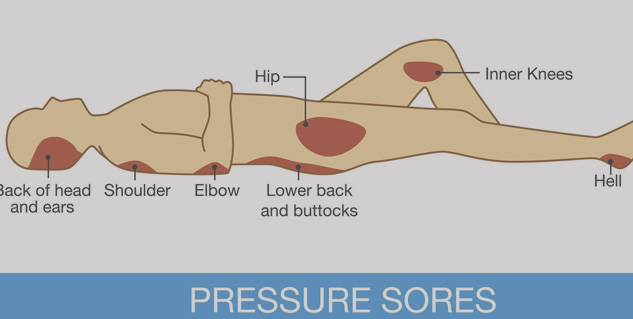 points_of_pressure_sores