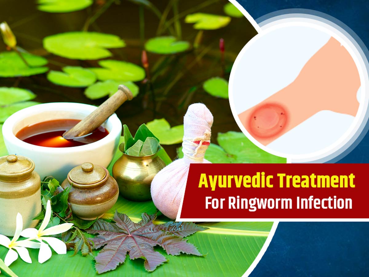 Herbal antifungal treatments for ringworm