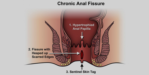 anal_fissure