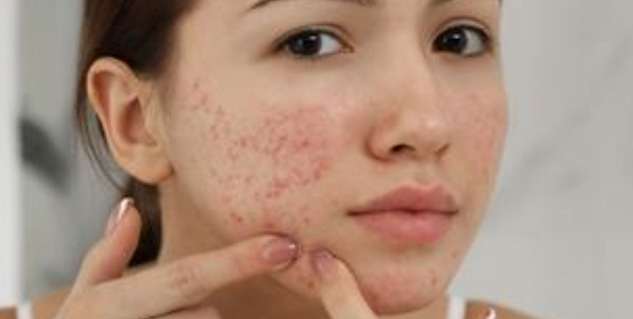 acne i pregnancy