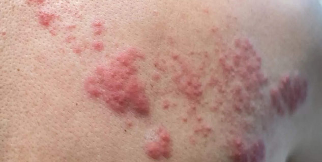 infection_in_inner_thighs