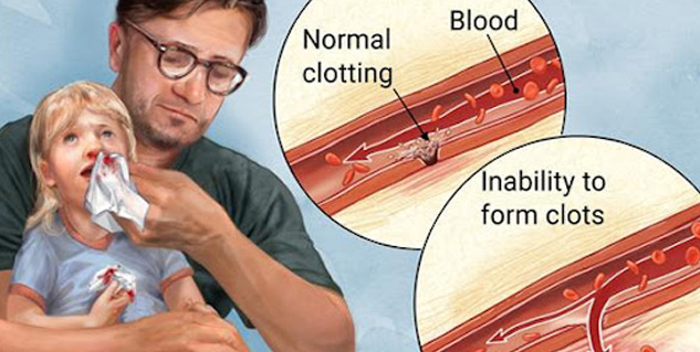 Haemophilia Blood Disorder: Know 7 Myths And Surprising Facts Behind ...