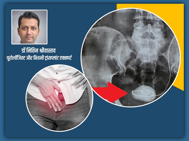5 सेमी पथरी का डॉक्टर ने 10 मिनट में कर दिया सफल ऑपरेशन, 24 घंटे में ही मरीज हुआ डिस्चार्ज