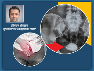 5 सेमी पथरी का डॉक्टर ने 10 मिनट में कर दिया सफल ऑपरेशन, 24 घंटे में ही मरीज हुआ डिस्चार्ज