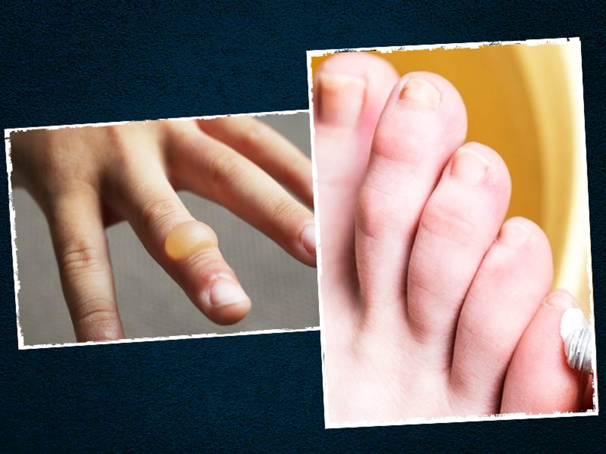 Alstublieft regionaal Handig How To Treat A Burn Blister? Try These Effective Remedies