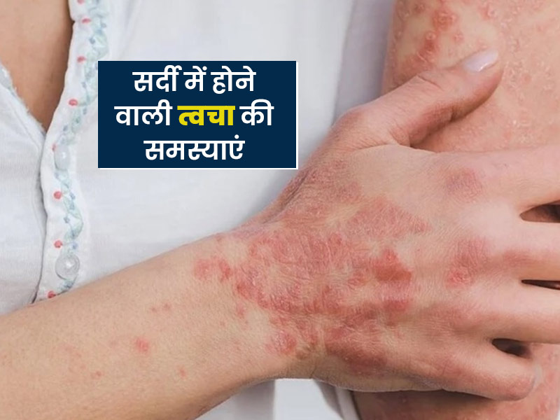 सर्दियों में आम हो जाती हैं ये 5 त्वचा समस्याएं, जानें इनसे बचाव के तरीके