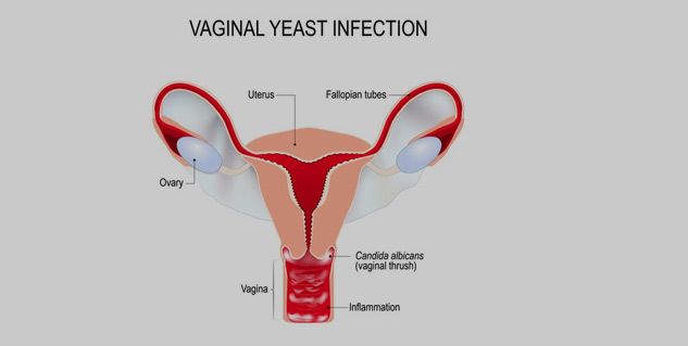 What are Vaginal Sores? All You Need to Know