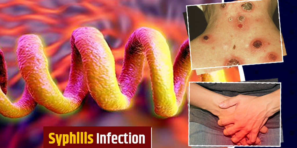 Syphilis Infection Know Symptoms And Stages Of This Bacterial