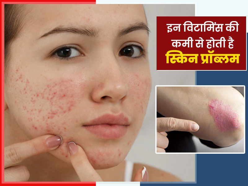 skin-problems-due-to-vitamin-deficiency-expert-explains-in-hindi