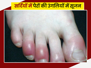 सर्दियों में पैरों की उंगलियों में है सूजन, तो अपनाएं ये 10 घरेलू नुस्खे