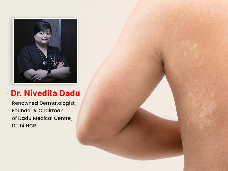 Tinea Versicolor on Skin: Know Symptoms, Causes, Treatment From Expert