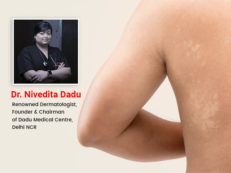 Tinea — Advanced Dermatology