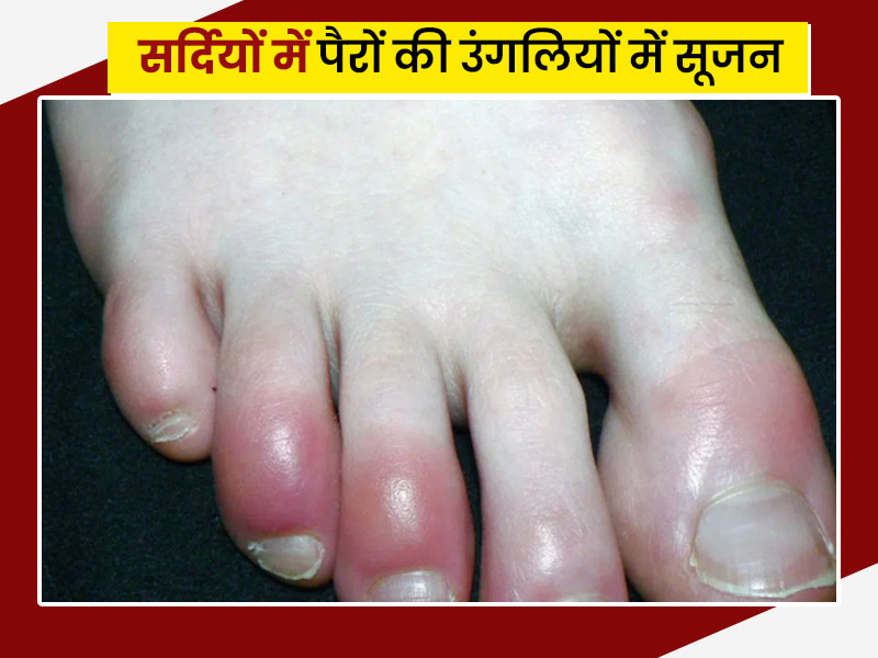 सर्दियों में पैरों की उंगलियों में है सूजन, तो अपनाएं ये 10 घरेलू नुस्खे