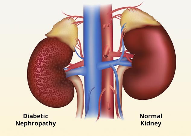 diabetic_kidney_disease