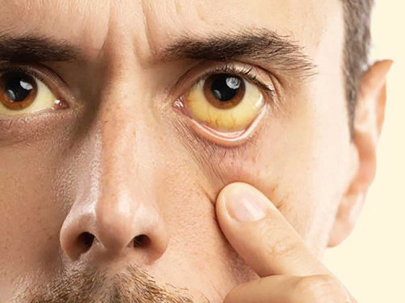 Doctor Debunks Common Jaundice Myths and Facts