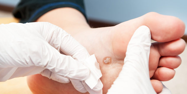 wart-in-kids