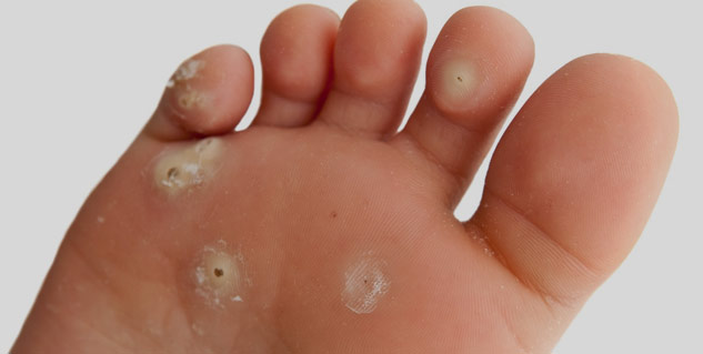 wart-in-kids