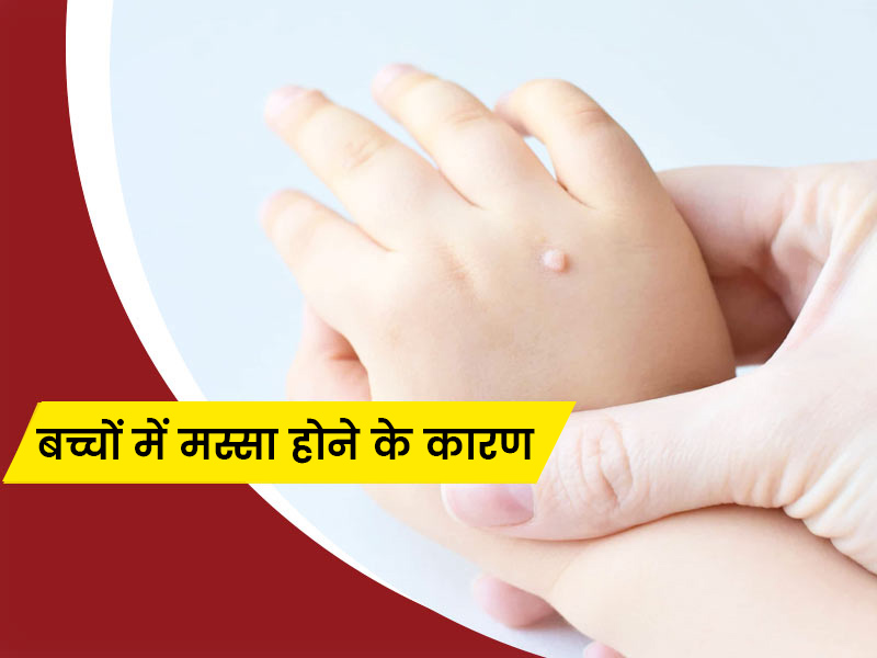बच्चों को मस्से होने के क्या कारण हैं? जानें अलग-अलग मस्सों के लक्षण और घरेलू उपाय