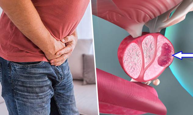 prostate cancer