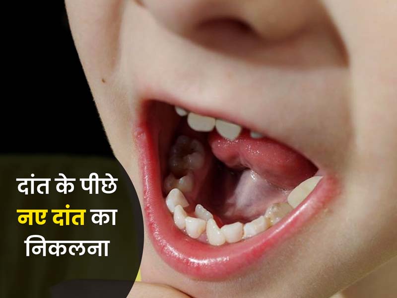 दांत के पीछे नए दांत का निकलने के हो सकते हैं ये 5 कारण, जानें बचाव के टिप्स 