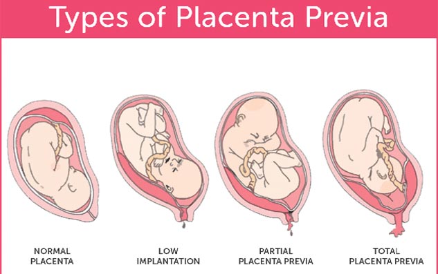Risk factors for placenta previa