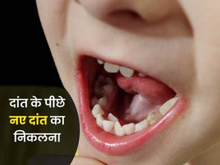 दांत के पीछे नए दांत का निकलने के हो सकते हैं ये 5 कारण, जानें बचाव के टिप्स 