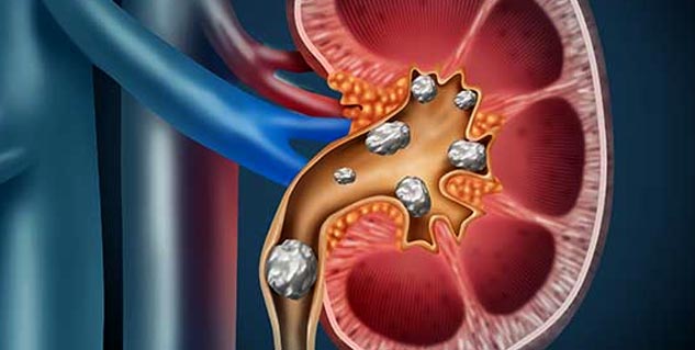 kidney stone