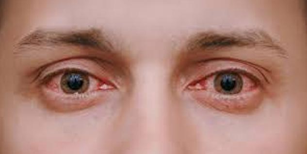 Troubled Due To Excessive Eye Blink? Know Causes, Treatment From The ...