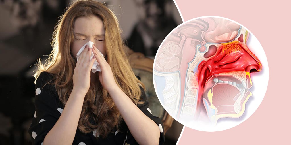 NonAllergic Rhinitis Symptoms, Causes And Treatment Onlymyhealth