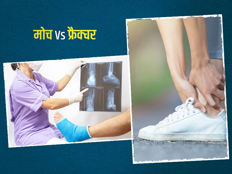 मोच और फ्रैक्‍चर में क्या अंतर होता है? जानें पांव में मोच आने के बाद क्‍या नहीं करना चाहिए