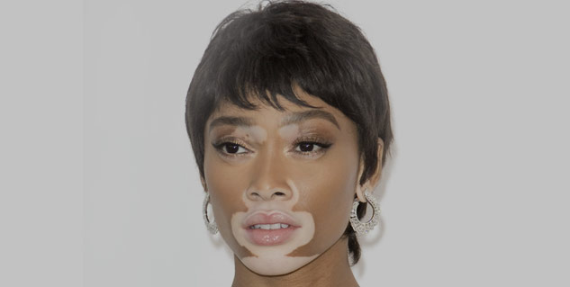 vitiligo skin care tips