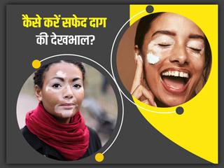 सफेद दाग होने पर इस तरह करें अपनी स्किन की देखभाल, समस्या में मिलेगी राहत