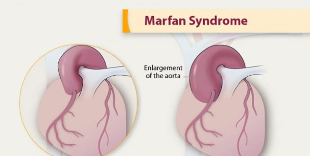 heart_marfan_syndrome