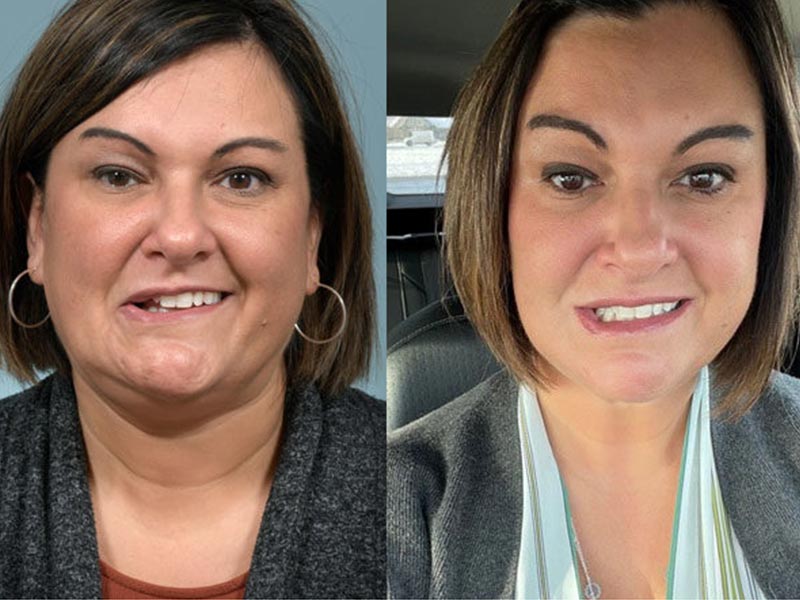 बेल्स पाल्सी और फेशियल पाल्सी (चेहरे का लकवा) में क्या अंतर होता है? जानें इनके लक्षण, कारण और इलाज