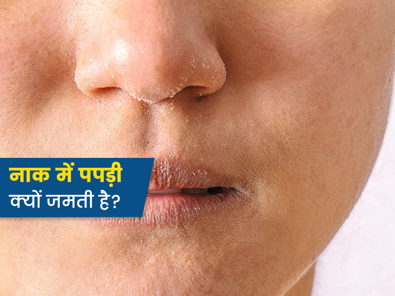 सर्दियों के दौरान नाक पर पपड़ी क्‍यों जमती है? जानें कारण और बचाव के उपाय