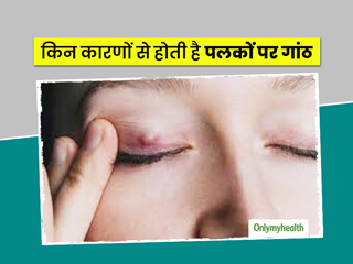 Chalazion: किन कारणों से होता है पलकों पर गांठ, जानें इसके 5 लक्षण, कारण और घरेलू उपचार