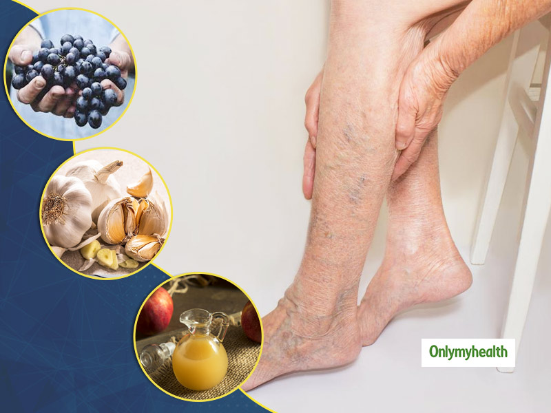 Varicose veins treatment - Natural Remedies