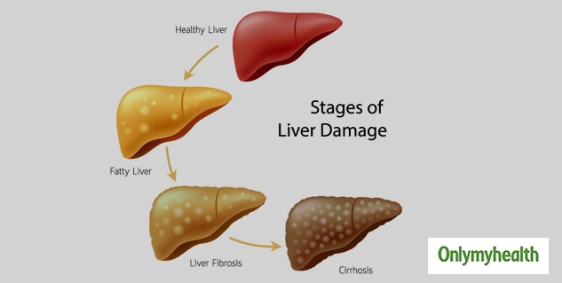 Primary Biliary Cirrhosis Life Expectancy Fatty Liver - vrogue.co