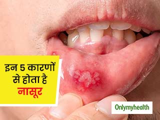 इन 5 कारणों से होता है नासूर, जानिए इसके 10 प्रमुख लक्षण और घरेलू उपचार