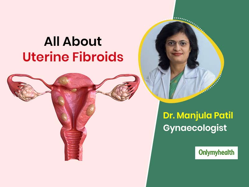 Women Must Know These Things on Uterine Fibroids