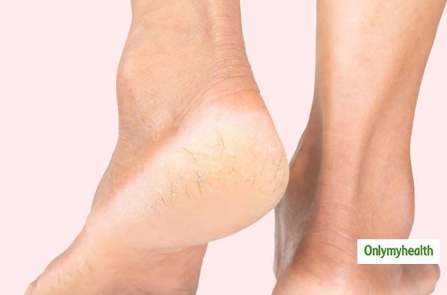 cracked heel solution