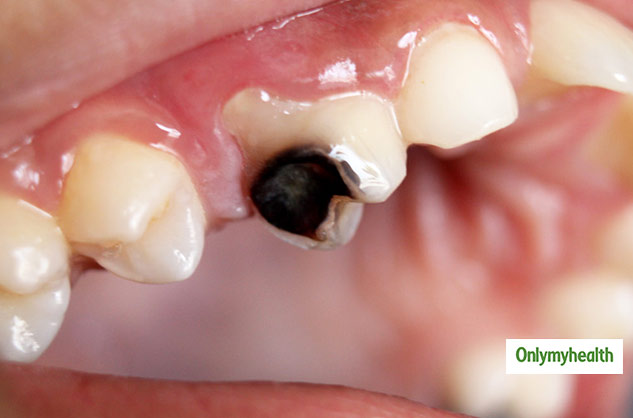Symptoms of Tooth Decay