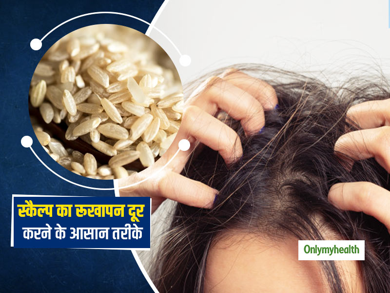 Dry Scalp and Hair Fall: Causes, Symptoms, Home Remedies and Diet to  Prevent Scalp Dryness by Expert in Hindi | ड्राई स्कैल्प (सिर के रूखेपन) का  कारण और दूर करने के घरेलू