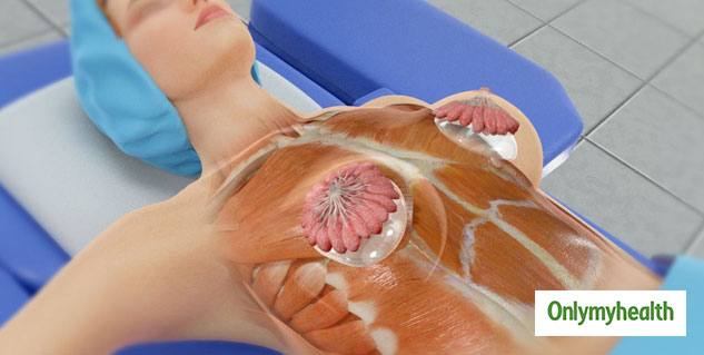 breast implant surgery