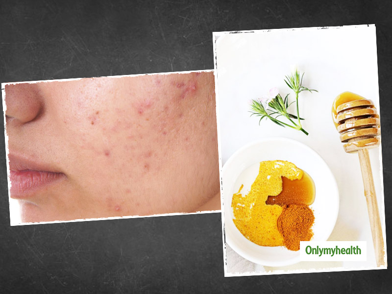 Pimple Popping Up: Types, Causes And Treatment For These Tender Bumps On Face