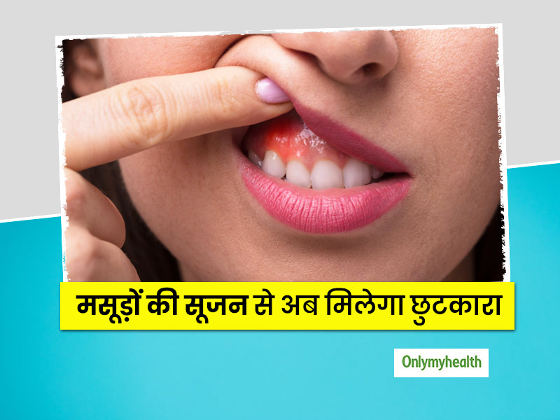 7 Home Remedies For Gingivitis And Toothache by Ayurveda Expert in Hindi | दांत  दर्द हो या मसूड़ों में सूजन की समस्या, आपके बड़े काम आएंगे 7 आसान घरेलू  उपचार | onlymyhealth
